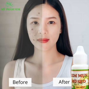 NDK Kem mụn mờ sẹo NL319 ngăn mụn làm mờ vết thâm giữ ẩm dưỡng da trắng mịn 8g