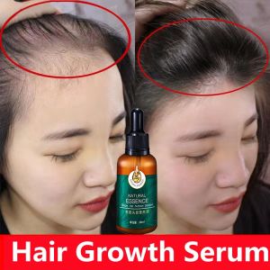 (Buy 1 Take 1)100% natural ginger Hair Serum Hair Grower Fast Long Hair Hair Treatment Minoxidil Hair Grower Castor Oil For Hair Growth Spray Essence Preventing Baldness Consolidate Hair Loss Treatment For Men And Women
