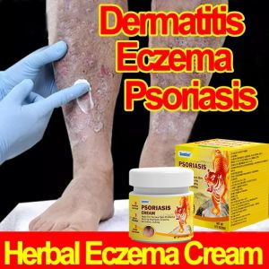 Eczema Cream Anti Itch Cream 30g Private Itching Eczema Cream Psoriasis Creams Dermatitis Itchy Skin Cream Herbal Anti Itch Cream Not Irritating Skin Bacteriostat For Adults And Kids