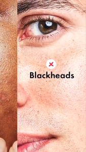 Tag Jerawat Invisible Acne Pimple Skin Patch 36 PCS - Transparent