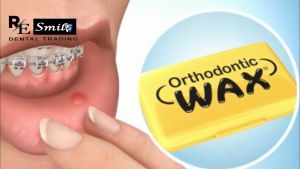 Resmile 1Pack Fruit Scent Ortho Wax For Gum Irritation