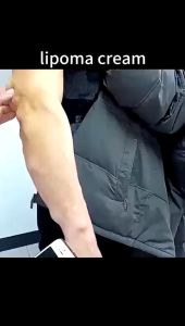 Lipoma Removal Cream lymphatic detox cream benjolan leher Lymph Care Armpit Neck Swelling Pain Relief