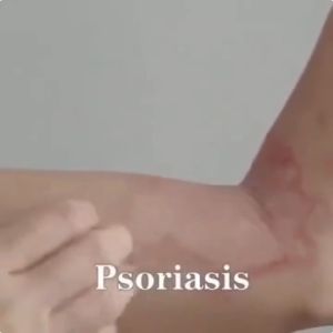 Psoriasis Treatment Cream Eczema Treatment Cream Anti Itch Cream For Skin medicine for itching itching in the skin ringworm cream for itching in the groin