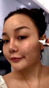 Obat Cream Remove Dark Spots Penghilang Flek - Jerawat - Bintik Noda Hitam - Komedo-CJ