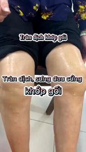 Kem Bôi Perfectx Mỹ 30g - Kem Phục Hồi Xương Khớp Giảm Đau Do Gud Và Phục Hồi Xương Khớp Xóa Tan Những Cơn Đau Nhức Cơ Xương Khớp Cải Thiện Viêm Khớp Dạng Thấp Nuôi Dưỡng Sụn Khớp Tăng Cường Xương Khớp Chắc Khỏe Dẻo Dai Linh Hoạt | Moska