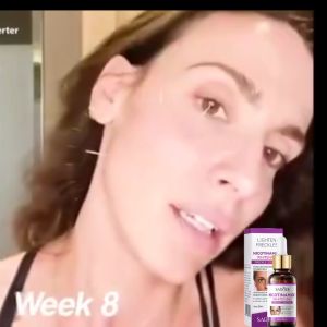 Niacinamide Whitening Serum Remove Acne Spot Melasma Pekas Freckle Anti Aging Moisturizing Essence