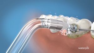 หัวฉีด Waterpik รุ่น OT100 สำหรับผู้ชาย/หญิงที่จัดฟัน คุณภาพสูงสุด ที่ใช้ได้กับทุกรุ่น คลิกที่ไหลเว็บไซต์ [เมลล์]