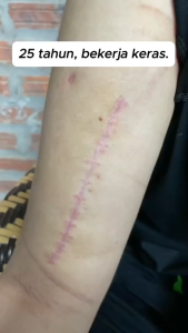 Scar Removal Cream Actiscar fades acne scars surgical scars and dark scars