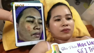 KEM C TÚ HOA – ULTRA SPOT ( 30g )