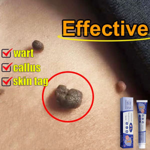 Penghilang Kutil & Skin Tag Remover: Solusi Terbaik untuk Menghilangkan Kutil Mata Ikan dan Kutil Kelamin