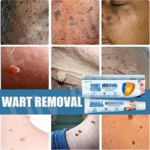 [EELHOE] Wart Removal Cream Krim Penghilang Lalat Kutil Mudah Dibawa Untuk Semua Kulit Krim Penghilang Kutil