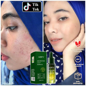 Serum Acne Jerawat 30ml Penghilang Bekas Jerawat Glowing Wajah dan Putih Pelembab Wajah