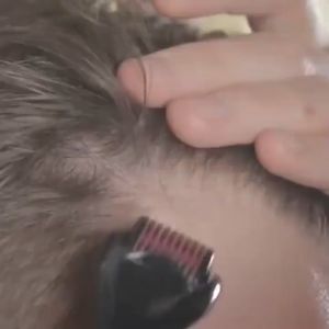 DRS 540 Needles: A Comprehensive Guide to Microneedling Rollers for Hair Growth & Skin Care