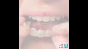 (FZFY SHOP)gigi palsu sarung original gigi palsu tooth cover gigi kosmetik smile 2 Pcs Smile Denture Fit Flex C