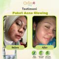 Orlin Beauty Paket Acne Glowing Platinum 4in1 Mencerahkan Wajah Kulit Sensitif Bekas Jerawat Flek Hitam Skincare BPOM. 