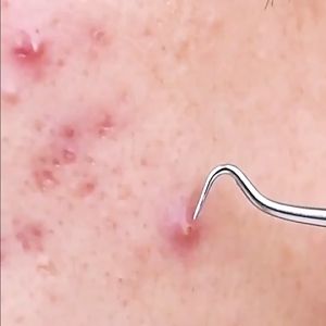 Acne Blackhead Removal Needle Tweezer Face Cleanser Extract Tool Clipper Pimple Kit Set Besi Picit Jerawat Facial