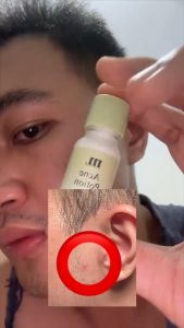 [BPOM] Moko Moko Acne Potion Acne Spot Treatment - Obat Totol Jerawat