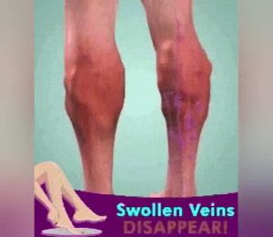 Kem Suy Giãn Tĩnh Mạch tinh chất thảo dược thiên nhiên cam kết an toàn và hiệu quả