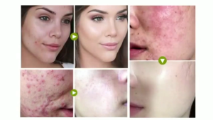 Remover Acne Cream  Acne Repair Cream  Shrink Pores  Quickly Pimple  Repairs Acne Pits  Anti Acne Spots  Treats pimples Acne Whiteheads and more.  Facial Scar Care   Whitening Moisturizing  Skin Care Repair Repairs  men and women  30g