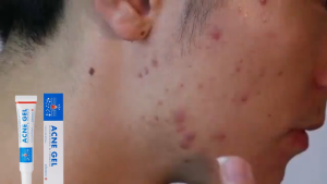 Gel Jerawat 30ml Produk Perawatan Jerawat Wajah Perawatan untuk Jerawat Wajah Produk Perawatan Jerawat Terlokalisasi.