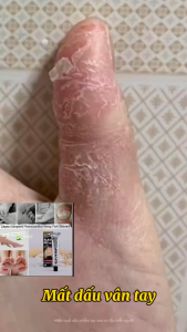 [ COMBO 3 ] Gel Nấm Da Tay Chân Nhật Bản Tam Chinkei Power In Gel Hiệu Quả Nhanh Chóng Giảm Ngứa Bong Tróc Da