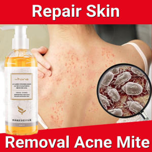 Skinvise Amino Acid Shower Gel Anti Itch Treats Acne Mites Reduces Goose Bumps Moisturizes Skin Whitening 260ml