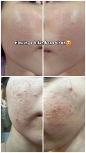 (COD) Solcare DERMAPEN Pink Ultima A1 BERGARANSI - Penghilang Bopeng