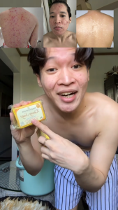 Kasoy Soap Original Acne Pimple Remover Eczema Remover Psoriasis Remover An-an Buni Kati Kati Sa Balat Skin Care By Natures Miracle