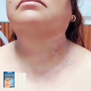 West Month Skin Tag Removal Patch 180pcs - Gentle Exfoliating Skin Care Stickers with Salicylic Acid Smooth Skin Patches for Daily Beauty Care