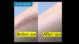 Scar Removal Cream Acne Scars Pimple Marks Stretch Marks Dark Spots Repair Cream For Face Skin Care