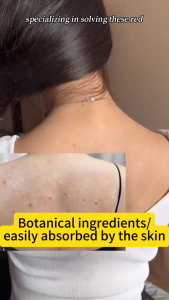 【SG SELLER】Acne Care Spray  60ml Body Acne Treatment Anti Acne Anti Mite for Back Chest Pimple Fade Acne Mark