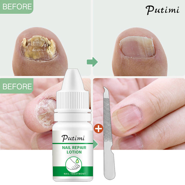 PUTIMI antibacterial nail treatment essential oil for onychomycosis