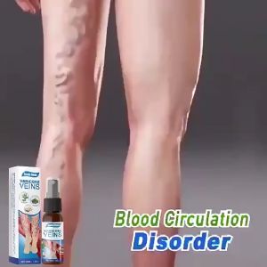 【Hot Sale】South Moon Varicose Vein Soothing Spray Ubat urat Varicose Veins treatment cream Vasculitis Treatment 靜脈曲張