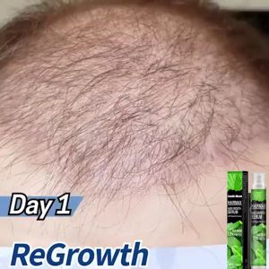 *Buy 1 Take 1* Hairmax HairGrowth for men and women best use to treat hair fall hair loss alopecia areata grey hair white hair pattern baldness hair growth spray organic hair solution Fast Powerful Pure Natural hair grower best treatment for hair problem