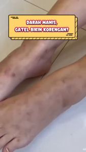 TABOYA Zhang Ru Cream - Atasi Semua Permasalahan Kulit / Penghilang Bekas Luka Dan Noda Hitam Bekas Jerawat