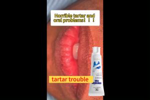 LYDIMOON Toothpaste remove smoke stains tartar 牙齿美白霜 Yellow teeth turn white 100g Cleaning tooth surface stains