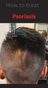 NANO HAIR GROWTH CLINIC SDP Tonic
