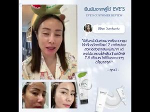 ส่งฟรี/ส่งไว EVES เซต สิว ผิวติดสาร อีฟส์ สิว ผิวแพ้ง่าย ครีมรัก ษาสิว แพ้ครีม ครีมลด สิวอุดตัน สิวอักเสบ