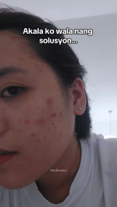 VERDEFY Scar Cream 10g for Acne Marks Pimple Marks Darkspot Stretchmarks