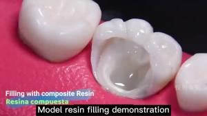 A1 A2 A3 Universal Dental Light Curing Composite Resin for Tooth Restoration Dental Materials Available In 3 Colors