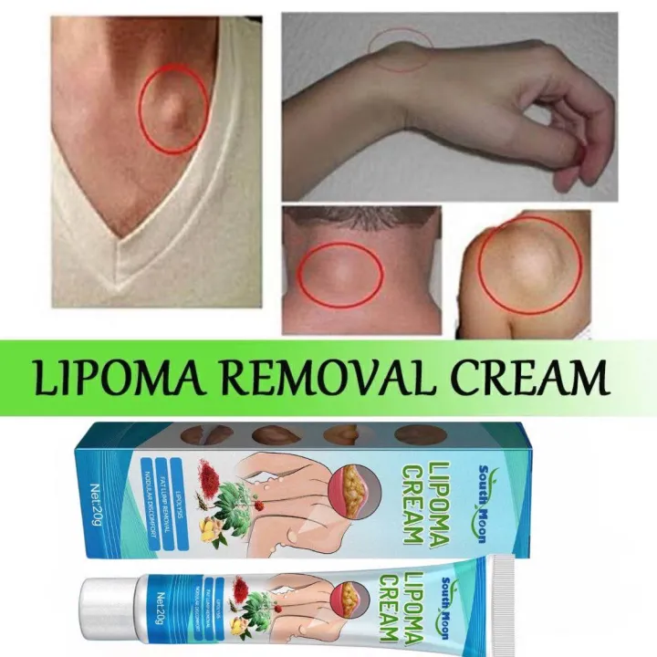 SOUTHMOON%20LIPOMA%20REMOVAL%20CREAM%20krim%20pembersih%20lipoma%20limfa%20ketulan%20keras%20ketiak%20leher%20belakang%20telinga%20buang%20detox%20badan%20-%20Image%209