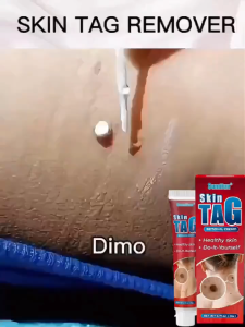 Mole Remover Skin Tags Remover Wart Non Irritating Herbal Dark Spot Treatment Gel Face Skin Care Tools Painless Moles Remover Antibacterial Ointment