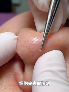 Upgraded 6-in-1 Acne Treatment Tool Kit with Mirror Case for Removing Blackheads Pimples and Fat Granules