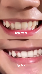 Go Smile Pasta Pemutih Gigi Charcoal - Bright Me Smile Charcoal Tootpaste Bpom