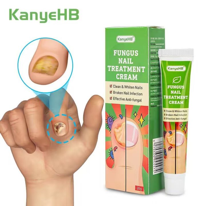 KanyeHB Fungus Nail Treatment Cream Krim kulat kuku krim kuku