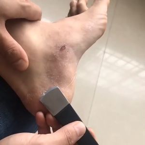 ชุดมีดตัดเล็บขบ ขูดหนังด้าน ส้นเท้าด้าน แซะเล็บขบ เซาะเล็บขบ งัดเล็บขบ