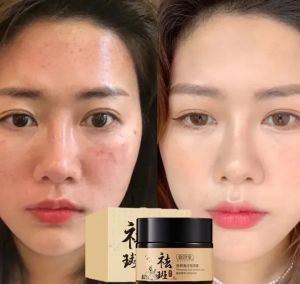 Krim Pemutih Bintik Wajah Efektif Melasma Pigmen Bintik Hitam Pigmentasi Perawatan Kulit. Dapat digunakan saat menyusui.