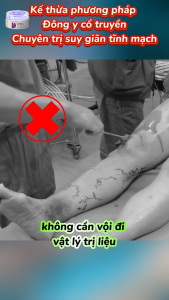 Kreain Gel Tím Cải Thiện Giãn Tĩnh Mạch Đau Và Sưng Dưới Chân Tĩnh Mạch Nổi Chuột Rút Tê Mỏi Chân Giun