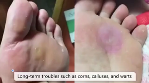 10 Pcs Foot Corn Patches Wart Removal Patches Callus Removal Foot Corn Treatment Patches Remove Calluses Relieve Corns Plantar Warts Stinging
