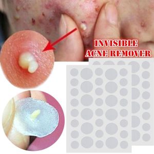 36PCS/Sheet Waterproof Acne Pimple Patch Salicylic Acid Hydrocolloid Acne Treatment Stickers Pimples Removal Facial Skin Care